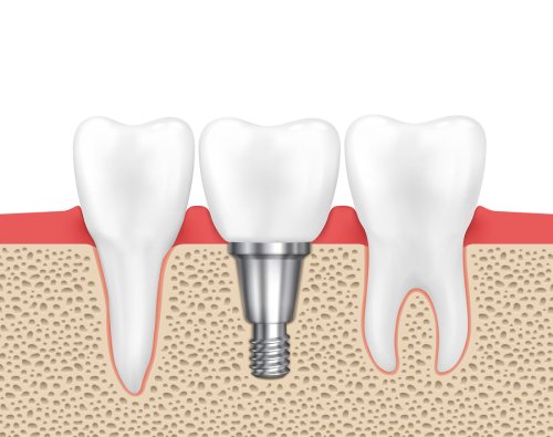 dental - implants
